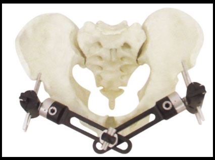 Braced Fixator Allanol Asgwrn Ffibr Carbon PEEK PEEK Carbon Fiber Bone External Fixator bracket